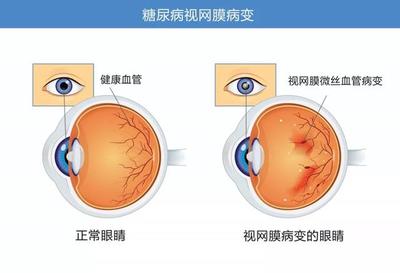 买个视网膜要多少钱